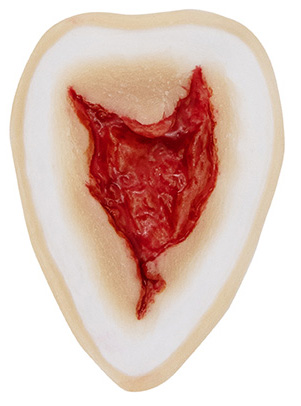 [3D-SB-W3] Wound 3 Silicone