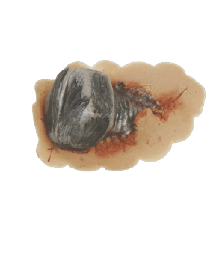 [3D-LR-WS1] Wound with Screw (7cm) Latex Rubber